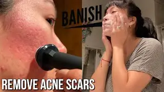 Trying BANISH Products for 1 Month | At-home Microneedling Results