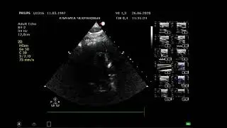 ULTRASOUND OF THE HEAD AND NECK VESSELS IS NORMAL