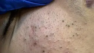 Get rid of blackheads and pimples with deep cleansing techniques