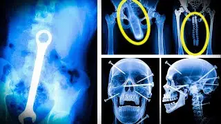 Top 10 Shocking X Ray Discoveries You Won't Believe! (Hidden Secrets Exposed)