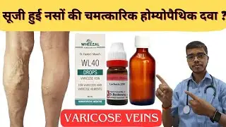 Say Goodbye to Varicose Veins Forever | Vericose vein Homeopathic Treatment