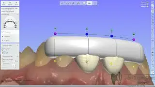 Цифровой Wax up и ключ для переноса/Digital Wax up and transfer key