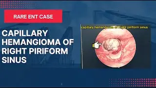 capillary hemangioma of Right piriform sinus
