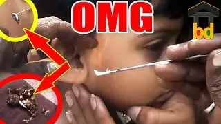 ►Relief for Life II Little Girl's Hard & Blocked Earwax Removal