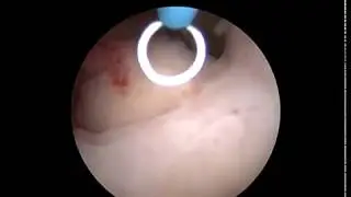 myom SX resektoskop 4,0mm ambulantně