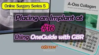 Placing an Implant at #16 Using OneGuide with GBR