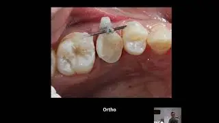 Ortho Extrusion