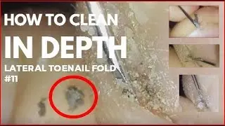 How to clean in depth lateral toenail fold #11