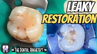 Replacing an Old Restoration While Preventing Recurrent Caries 