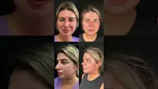 7 дней после подтяжки шеи и пластики носа #платизмопластика #ринопластика