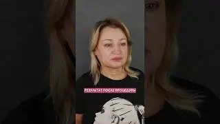 До и после процедуры FULLFACE