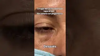 Comparte. La carnosidad cuando crece provoca astigmatismo y en casos avanzados puede tapar la visión