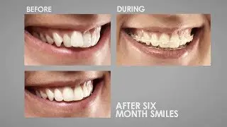 Clear Braces Cardiff - What Are Ceramic Fast Braces? | Birchgrove Dental Practice
