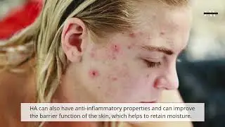 Revamin Acne Cream Review  4