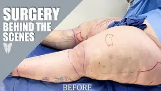 Lipedema Reduction Surgery | Behind the Scenes