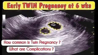 6wks Early TWIN Pregnancy - what are Complications of TWINS