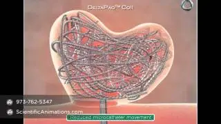 3D Medical Animation Deltacoil Showcase MicrusEndovascular