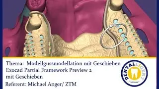 FREE EXOCAD TUTORIAL-FULL MOVIE - Modellgussmodellation mit Geschieben -in voller Länge 28 Min