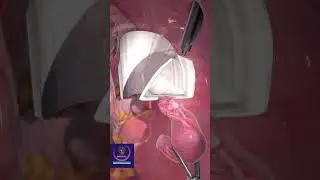 Laparoscopic Tissue Removal 