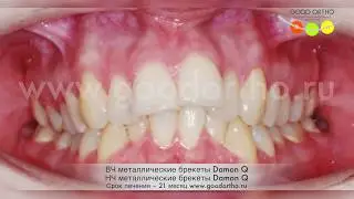 Исправлене прикуса на брекетах Damon Q