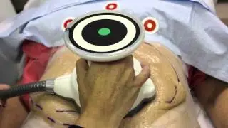Dr Kopelman does Ultrashape