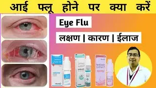 आई फ्लू - लक्षण कारण व ईलाज | Eye Flu hone par kya karen | Conjuctivitis | Eye flue treatment