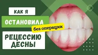 How I Stopped Gum Recession Without Surgery: 4 Minutes a Day, and My Gums Are Back in Place