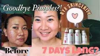 PAANO MAWALA ANG PIMPLES IN 7 DAYS? 🤔 | RYX SKINCERITY REVIEW (PART 1)
