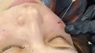20.04  ГК средняя треть. Канюля(фрагмент).