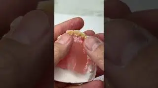 Saving 3 teeth