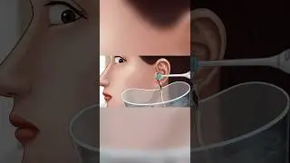 Asmr earwax blockage removal 