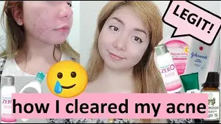 How I Healed my Acne in One Month Legit! | Acne Skin Care Routine | Oily Skin | Acne Prone