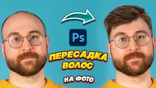 Пересадка волос на фото