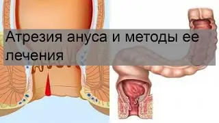 Атрезия ануса и методы ее лечения