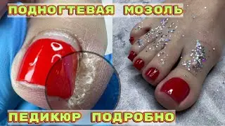 How to remove a subungual callus 🦶Pedicure in detail