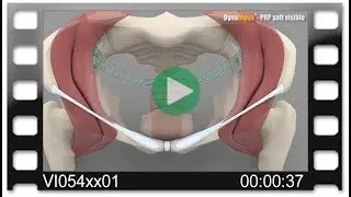 DynaMesh®-PRP - Animation: Pectopexy with Anterior & Posterior Mesh Repair