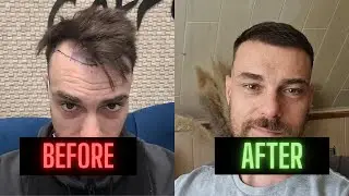 Hairtransplant Result after 5 months - before and after