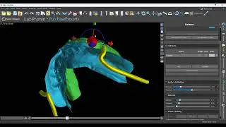 Waxups and Orienting Models in Occlusion in Blue Sky Plan