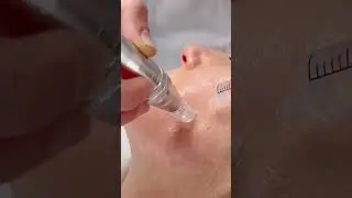 mesotherapy face #mesotherapy #mesoface #facemeso