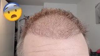 hair transplant turkey before after 9 weeks