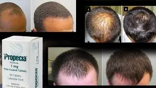 Long Term Finasteride Reverses Hair Loss: Stepwise Follicular Augmentation