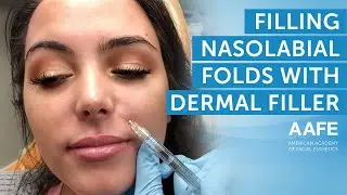 Filling and Smoothing out Smile Lines | AAFE