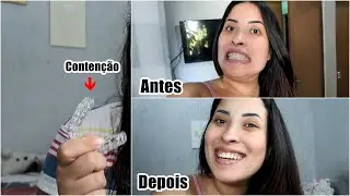 TIREI O APARELHO!!! MOSTRANDO MINHA CONTENÇÃO ESTÉTICA E CLAREAMENTO, QUANTO GASTEI?