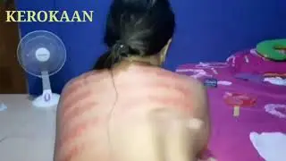 Kerokan masuk angin sampai merah