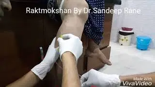 Raktmokshan for varicose Vein