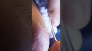 ingrown hair pull out speedx2 with tweezers!  Satisfying 248 #satisfying  #well  #removal #shorts