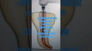 what are the methods of obturating a canal with gutta percha?