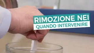 Rimozione nei: quando si deve intervenire?