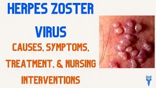 HERPES ZOSTER Symptoms, Causes, Treatment, & Nursing Interventions