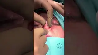 Fonksiyonel rhinoplasty - burun ameliyatı.